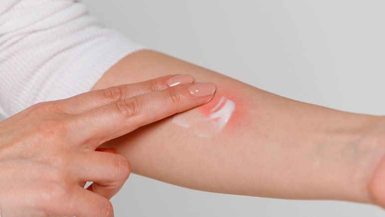 Descubre la revolución en cuidado de heridas: cremas cicatrizantes, tu aliado para una recuperación rápida y efectiva