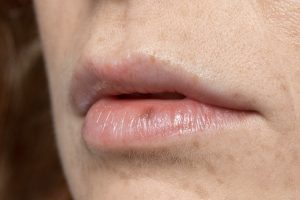 mejores cremas herpes labial
